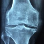 Bolestné body autonehoda